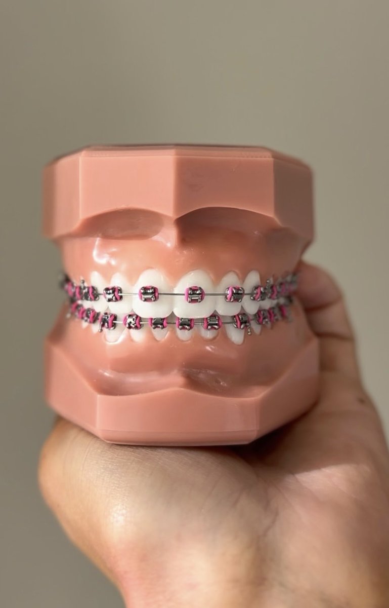 Pink braces are in for Valentine’s Day! #braces #pink #ortho #kc #orthodontist