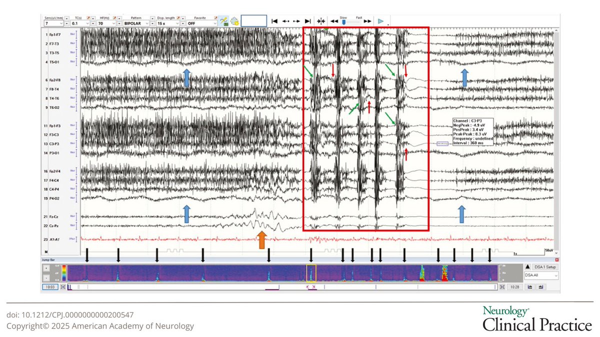 NeurologyCP's tweet image. Electroclinical Characteristics and Prognostic Significance of Postanoxic Oral Automatism: A Case Series and Literature Review hubs.la/Q040mp2d0

#NeuroTwitter