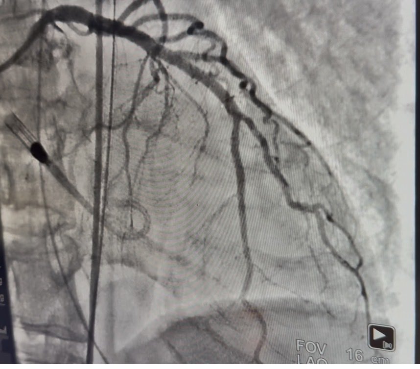 This afternoon reminded me of the heaviest part of what we do.

We took care of a young father of three who suffered an out-of-hospital cardiac arrest. The pre-hospital team did everything right—early AED use, rapid EMS response, high-quality CPR. 

🎯 Despite that, his total