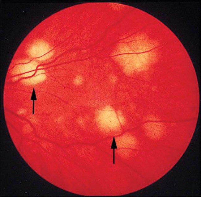 En <a href="/OFIDJournal/">Open Forum Infectious Diseases</a> hacer #FondoOjo👁️‍🗨️en #Candidemia🩸🍄?
🔹402 pacientes 76% fondo ojo
🔹4.9% afectación ocular➡️👁️ (corioretimitis o endoftalmitis)👉🏻En TODOS modificación tratamiento (más duración🗓️,cambio a #azoles🔄, adición➕o intravitreo💉👁️)
🔗🆓academic.oup.com/ofid/advance-a…
