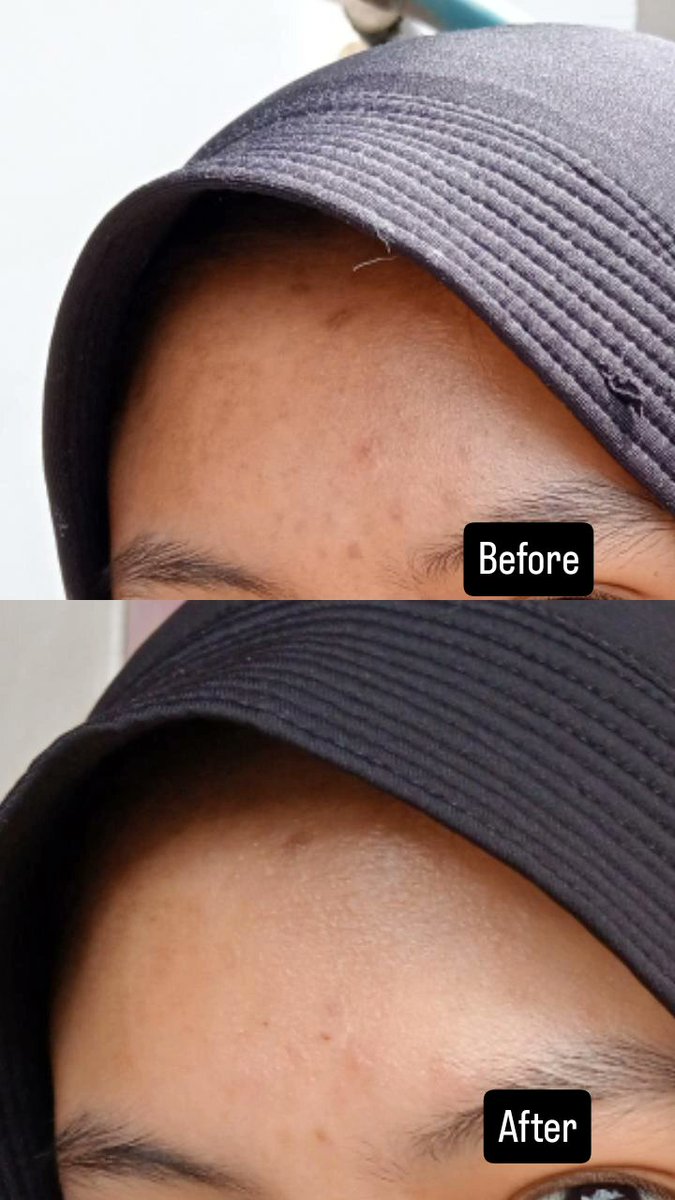 yuonnoona's tweet image. Banyak facewash low ph lain, tapi Low pH Good Morning Gel Cleanser dari COSRX, sebagai pioneer low ph face wash di Indonesia emang sengaruh itu sih di kulit aku. Pantesan selalu jadi best seller