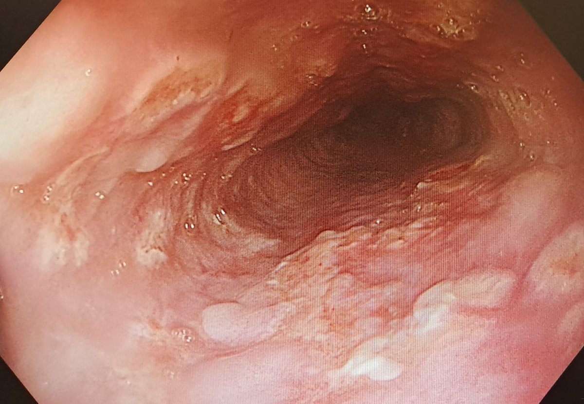 oviedendoscopia's tweet photo. Esofagitis por herpes simple https://t.co/6CXrBil5DL