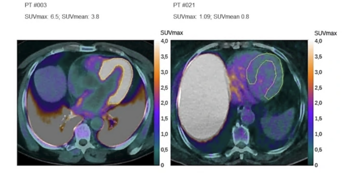 "Diagnostic performance of a machine learning approach applied to delayed [18F]florbetaben positron emission tomography in patients with suspected light-chain cardiac amyloidosis"

Giorgetti, A., Santarelli, M.F., Genovesi, D. et al.

rdcu.be/e1t9U