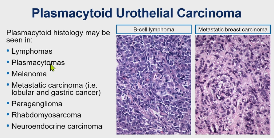 Bladder Plasmacytoid Urothelial Carcinoma

Pitfall ⚠️: It can stain CD138 positive (CD138 can stain epithelium).

Run a panel of IHC (pic 2).

Plasmacytoid histology can be seen in different neoplasms (see pic 3).

Dr. Magi-Galluzzi – 2025 Diagnostic Pathologic Update #USCAP