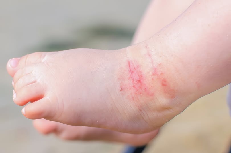 HospitalSBColon's tweet photo. 👧🧒Cuidar la piel de los más chicos en verano es clave Con el calor, los niños transpiran más y su piel necesita cuidados especiales🩵Mantenerla limpia y bien seca ayuda a proteger su barrera natural y a prevenir molestias frecuentes #VeranoSeguro #SaludInfantil #CuidadoDeLaPiel https://t.co/mMOeKcEpQm