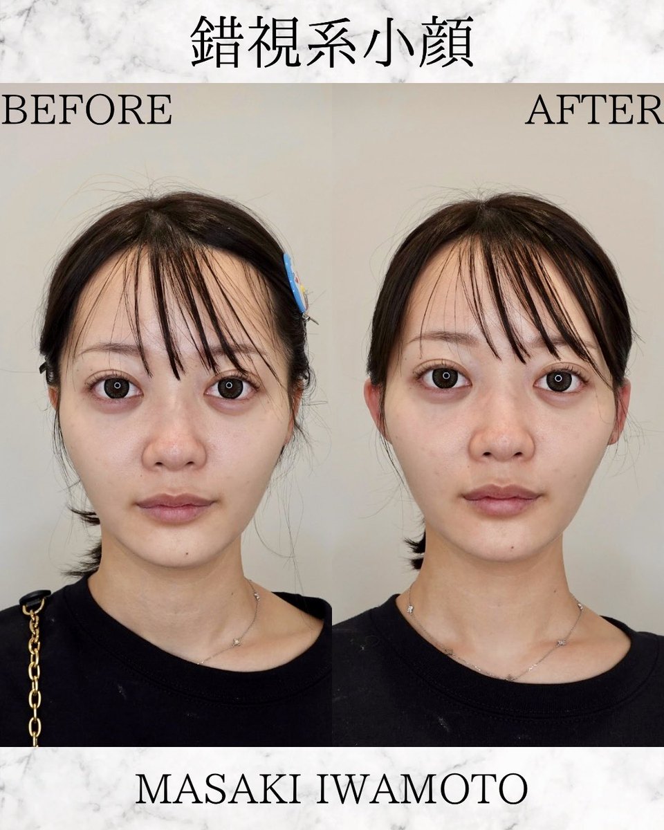 小顔整形/ヒアルロン酸】 岩本昌樹 (@dr_iwamoto) / Posts / X
