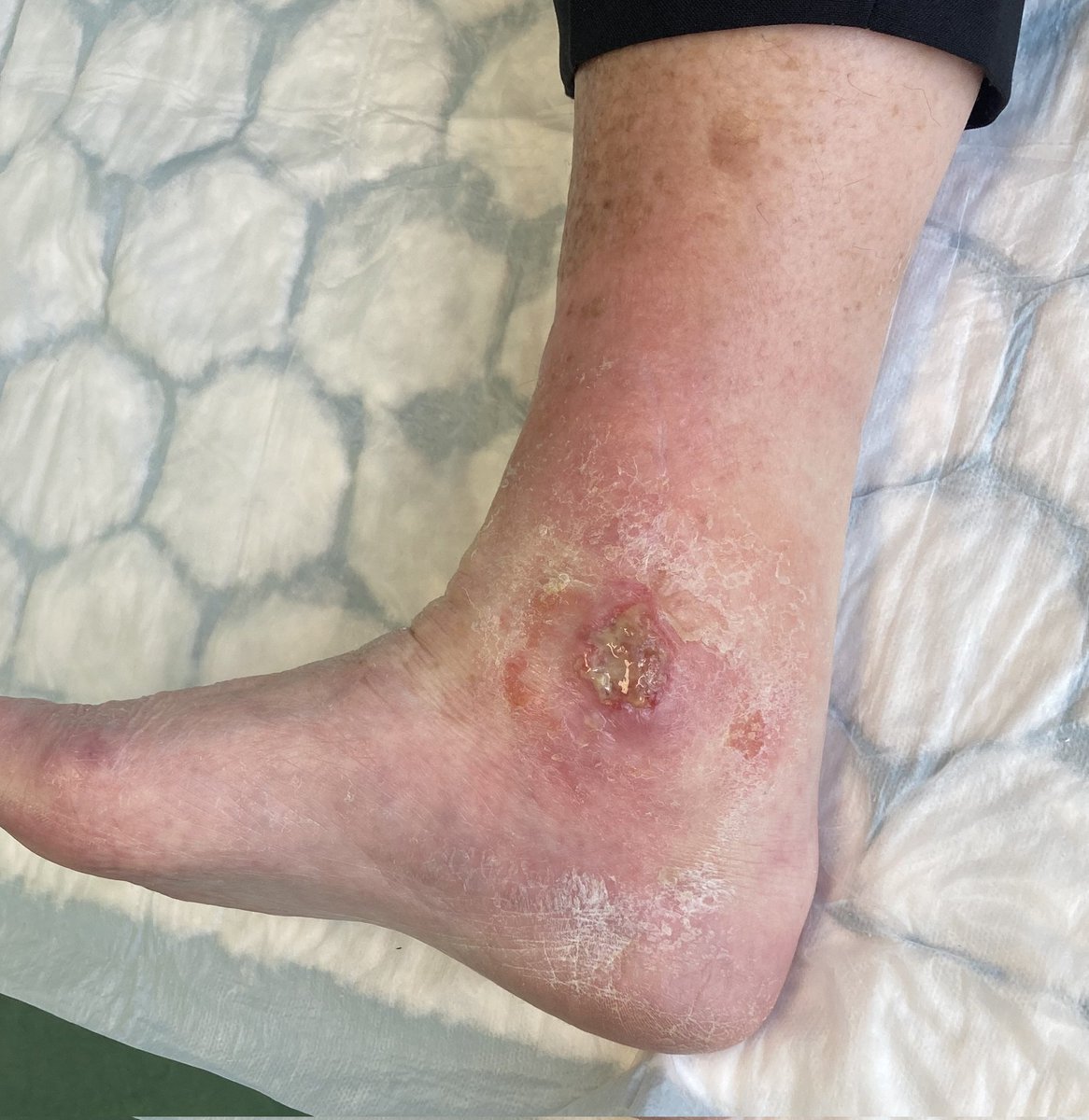kostasd87's tweet photo. @InvictaOrtho Current state of medial malleolar area https://t.co/iawJ0uzvCG
