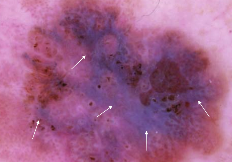 DermMarianne's tweet photo. 1⃣ Dermoscopic structure a day
🔵 Blue White Veil
Structureless area of confluent blue pigmentation that does not involve the entire lesion
+ overlying whitish “ground-glass” haze
🔬 Heavily pigmented tumor cells in dermis
#dailyscope https://t.co/3w9BD2yKcE