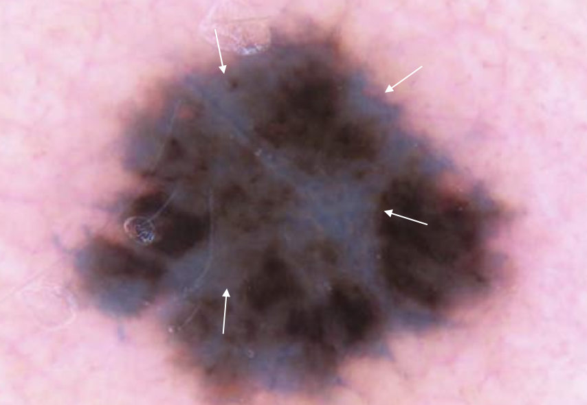 DermMarianne's tweet photo. 1⃣ Dermoscopic structure a day
🔵 Blue White Veil
Structureless area of confluent blue pigmentation that does not involve the entire lesion
+ overlying whitish “ground-glass” haze
🔬 Heavily pigmented tumor cells in dermis
#dailyscope https://t.co/3w9BD2yKcE