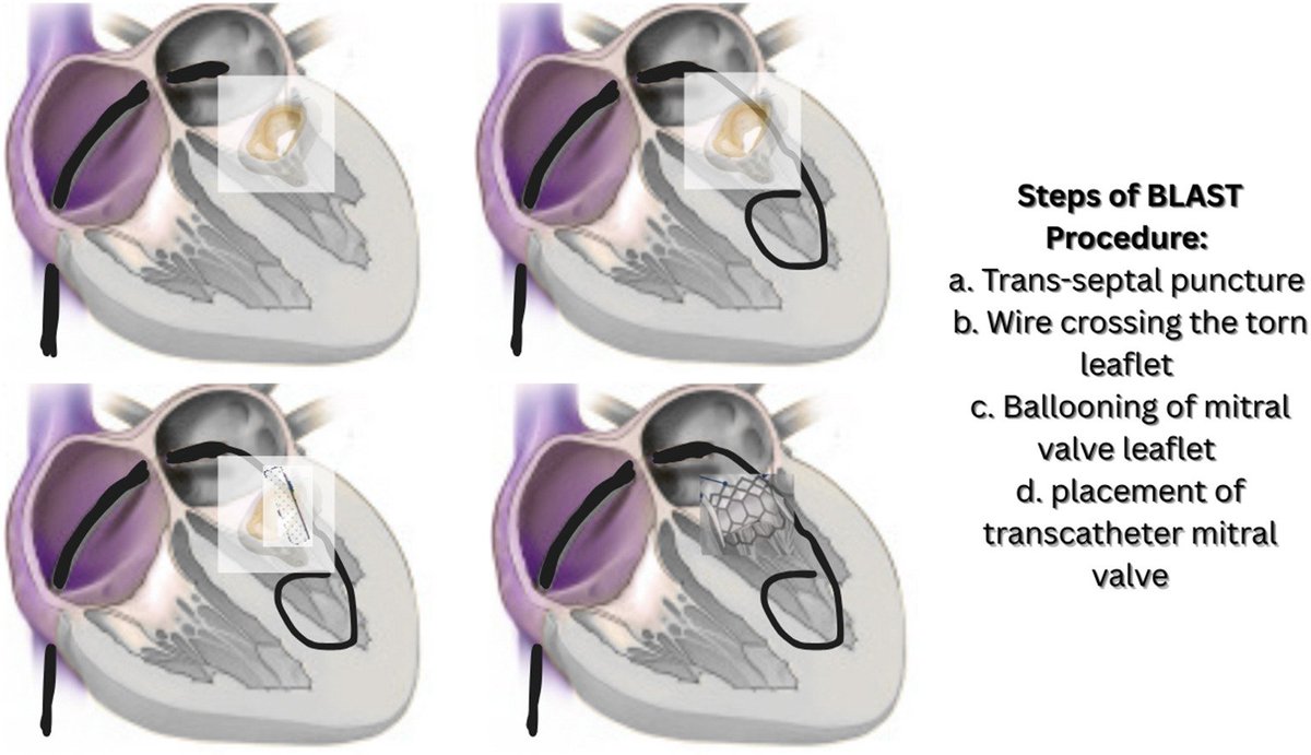 CRMjournal's tweet image. Congratulations to the January 2026 CRM: IC Case of the Month!

"Balloon-assisted laceration &amp;amp; snaring technique (BLAST) of the anterior mitral leaflet to prevent #LVOT obstruction during #TMVI"

Check out the interview of @kdahal11 by @GiorgioMedranda!

crtonline.org/video-detail/b…