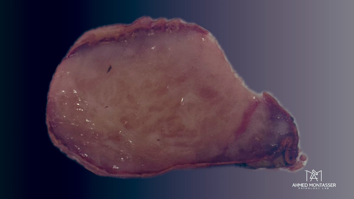 AMontasserMD's tweet photo. Weekend treat 🍬

C L A S S I C 🏛️

Organ? diagnosis ? 🤔 

#Pathology #Endocrine #PathTwitter #PathX https://t.co/NKwmNgkm0Y