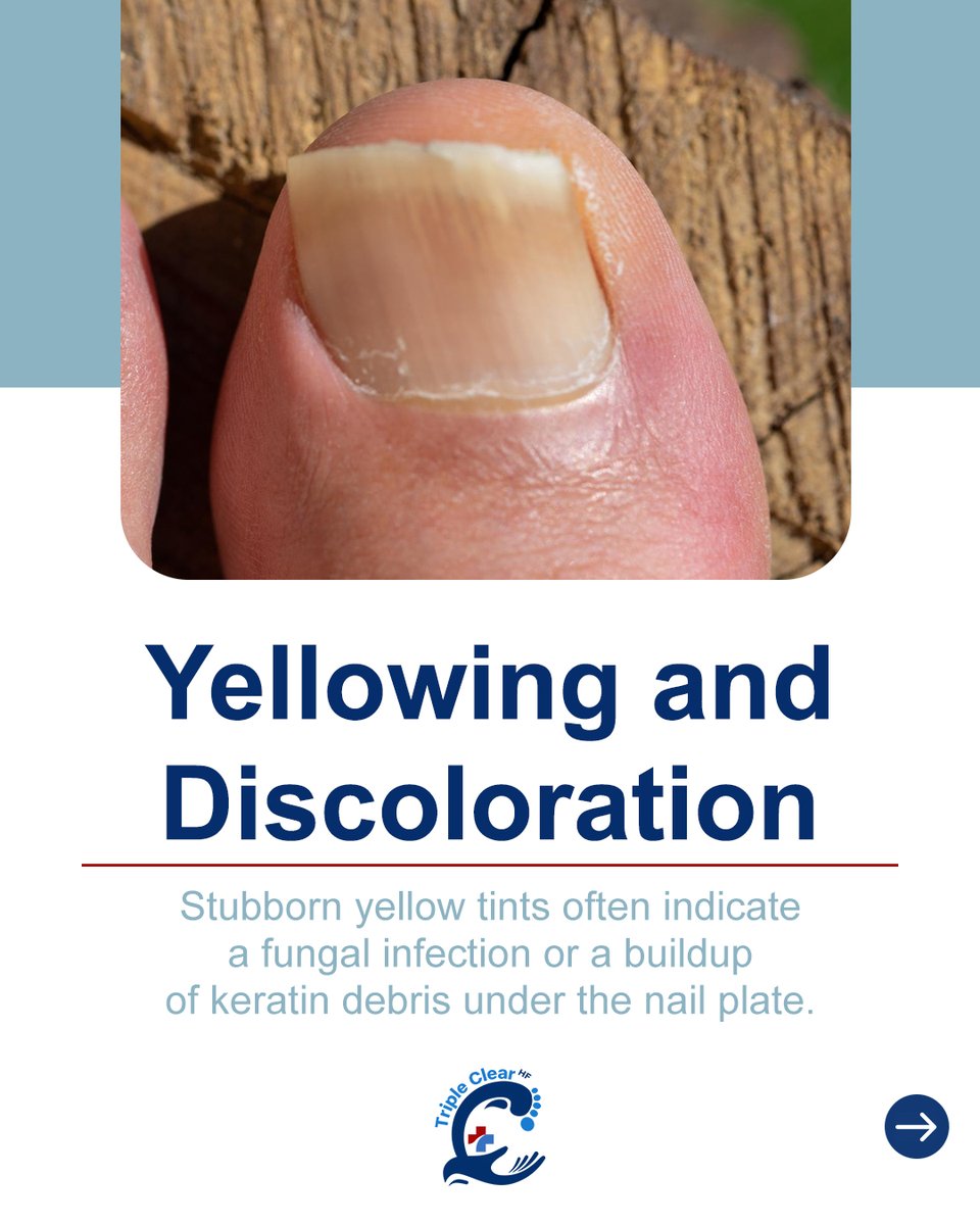 TripleClearHF's tweet image. Yellowing, white spots, or dark patches can reveal fungal infections, mineral deficiencies, or trauma.

Triple Clear HF addresses the root cause naturally, restoring nail strength, clarity, and resilience: TripleClearHF.com

#NailHealthTips #HealthyNails #TripleClearHF