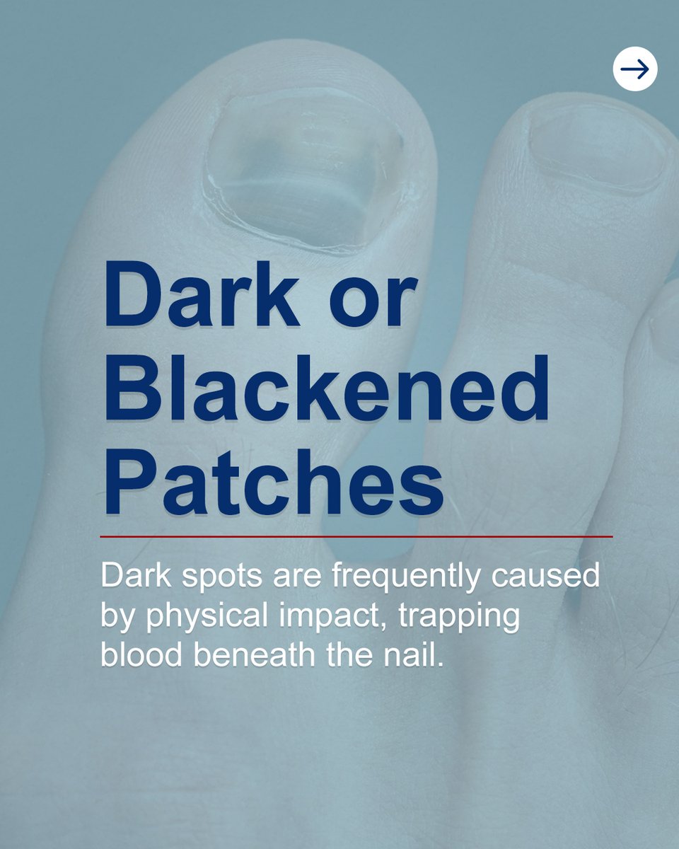 TripleClearHF's tweet image. Yellowing, white spots, or dark patches can reveal fungal infections, mineral deficiencies, or trauma.

Triple Clear HF addresses the root cause naturally, restoring nail strength, clarity, and resilience: TripleClearHF.com

#NailHealthTips #HealthyNails #TripleClearHF