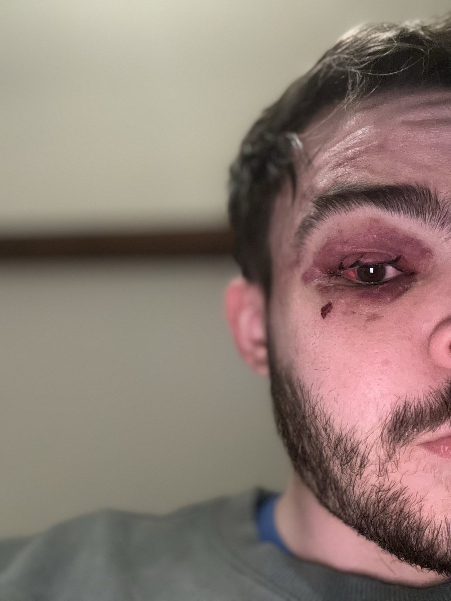 BryanTeamdems's tweet image. @OM_Officiel  @ClubBrugge  

Être supporter ne devrait jamais exposer à ça

Après le match #BRUOM mes deux amis et moi avons été agressés par 15 personnes cagoulées et masquées, sans aucune provocation de notre part 

Je souffre d’une fracture de l’orbite gauche

 #TeamOM  #OM