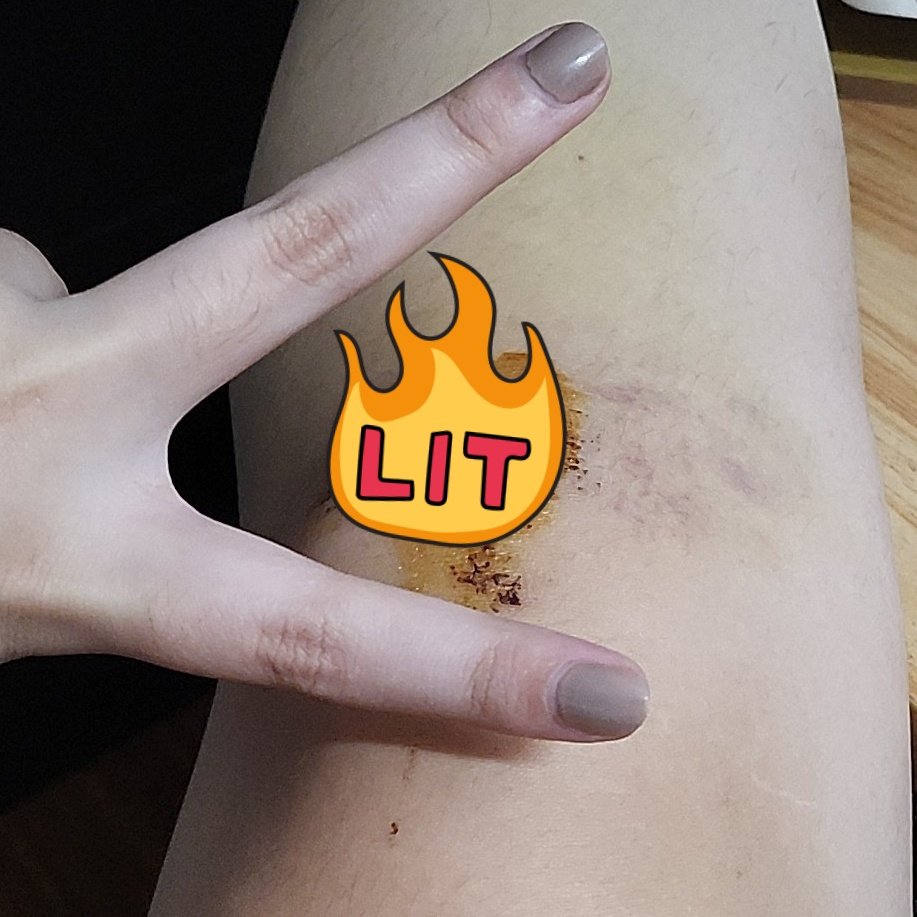 life update:
SAFE ANG TUHOD 🧚‍♀️✨️
Not my mind tho, was too anxious to walk I have to hold on to my bro kase nga baka mabangasan nanaman si tanga 🫩