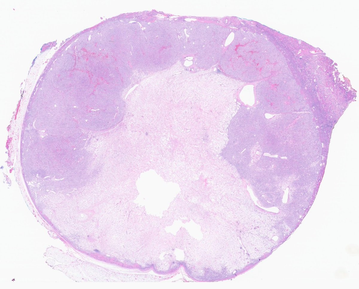 slusagar's tweet image. 😍#GUpath #grosspath correlation on this partial nephrectomy

clear cell RCC with myxoid degeneration

🚨can be pitfall for calling tumor cell necrosis (a bad prognostic finding)