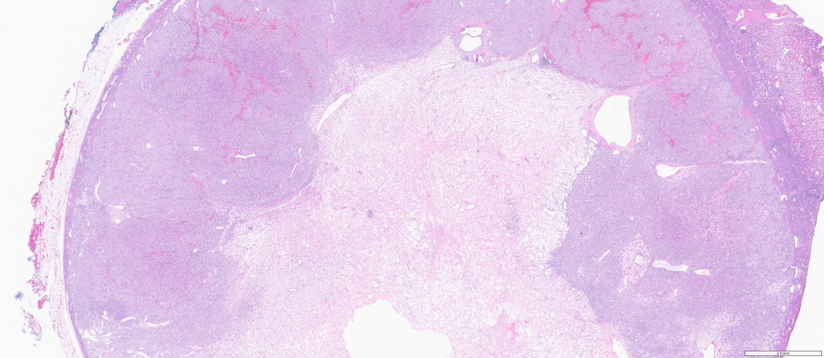 slusagar's tweet image. 😍#GUpath #grosspath correlation on this partial nephrectomy

clear cell RCC with myxoid degeneration

🚨can be pitfall for calling tumor cell necrosis (a bad prognostic finding)