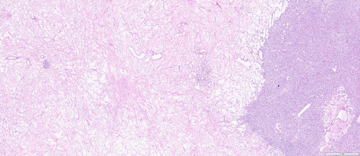 slusagar's tweet image. 😍#GUpath #grosspath correlation on this partial nephrectomy

clear cell RCC with myxoid degeneration

🚨can be pitfall for calling tumor cell necrosis (a bad prognostic finding)