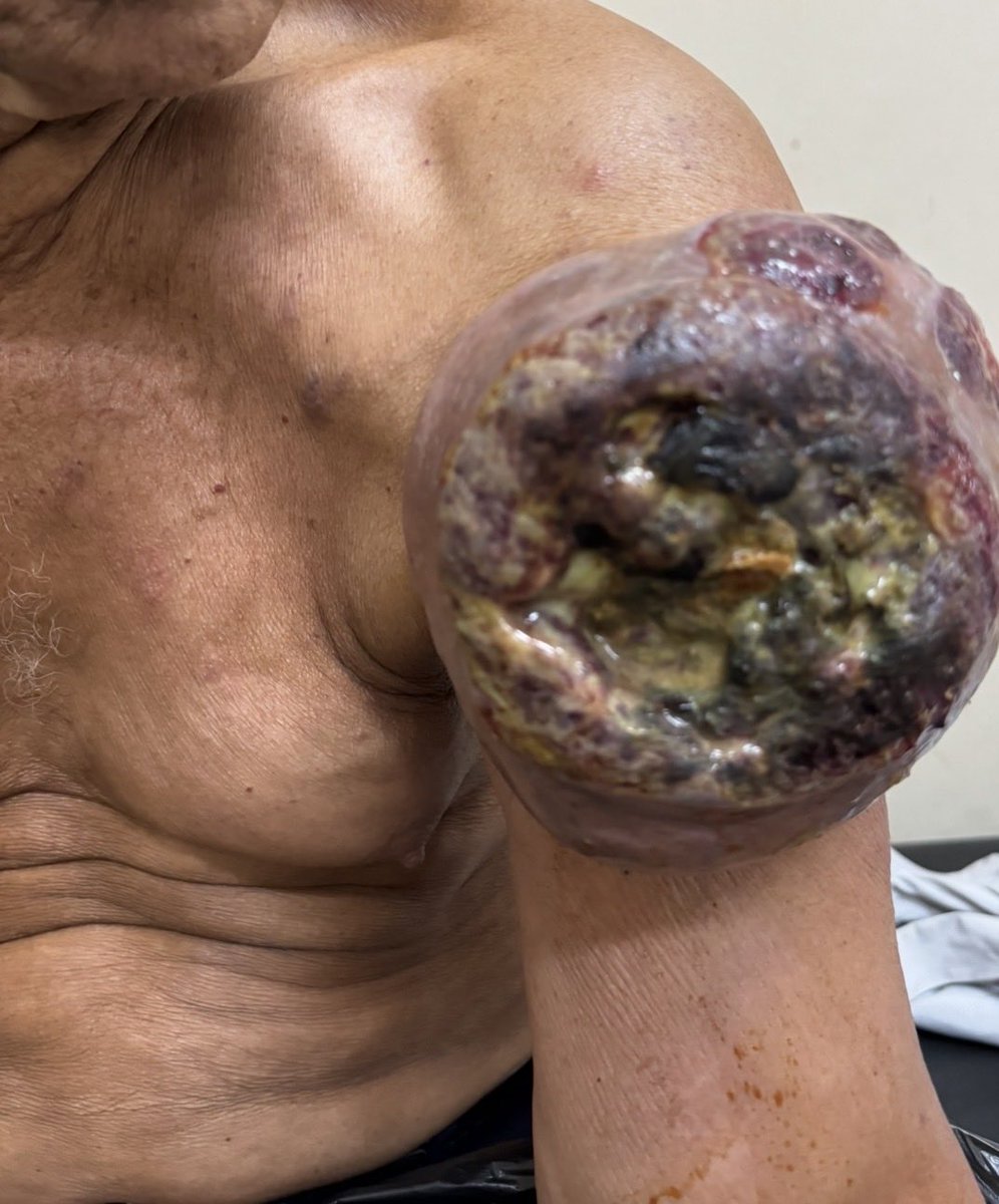 Osteosarcoma extraóseo - Instituto Nacional del Cáncer- Prof. Dr. Manuel Riveros-Capiata PY