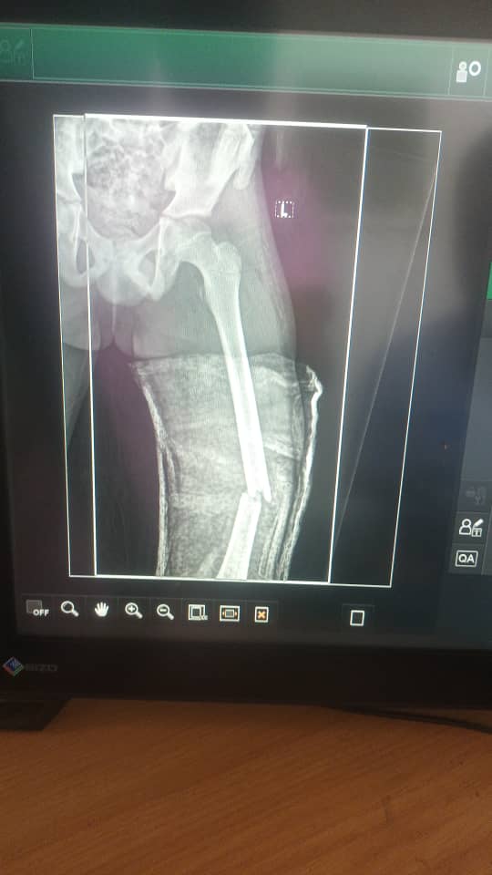obertdube_poet's tweet image. A 10 yr old child broke his thigh when a tree fell on him .he has been admitted at Vic Falls hospital for 20 days.
He is supposed to be taken to Bulawayo but  the mother has been told she should fuel the ambulance, $300 needed.
Metrina
0777375706(ecocash)
Pliz help
Retweet this
