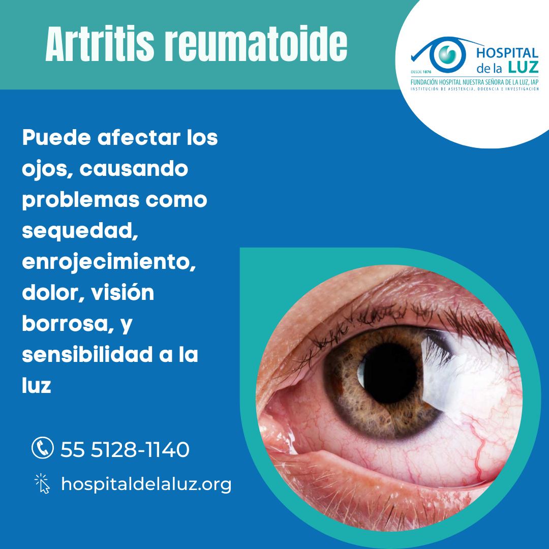 La artritis reumatoide (AR) puede afectar los ojos causando problemas como sequedad, enrojecimiento, dolor, visión borrosa, y sensibilidad a la luz.