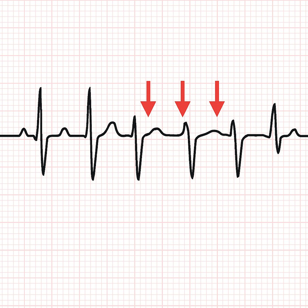 DrNicoleSCasey1's tweet photo. 🫀ECG quick tip for residents:
Subtle ST elevation in V1–V3 is often missed.
Always scan anterior leads systematically — even when the ECG looks “almost normal.”
#ECGlearning #MedEd #Cardiology https://t.co/6SqglaQ6vy