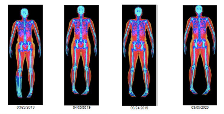DEXalytics's tweet photo. How does body composition change following Achilles reconstructive surgery?  Find out here: https://t.co/Z2XtRgD2lh
#DXA #NCAA #sports https://t.co/onNEnzfmcZ