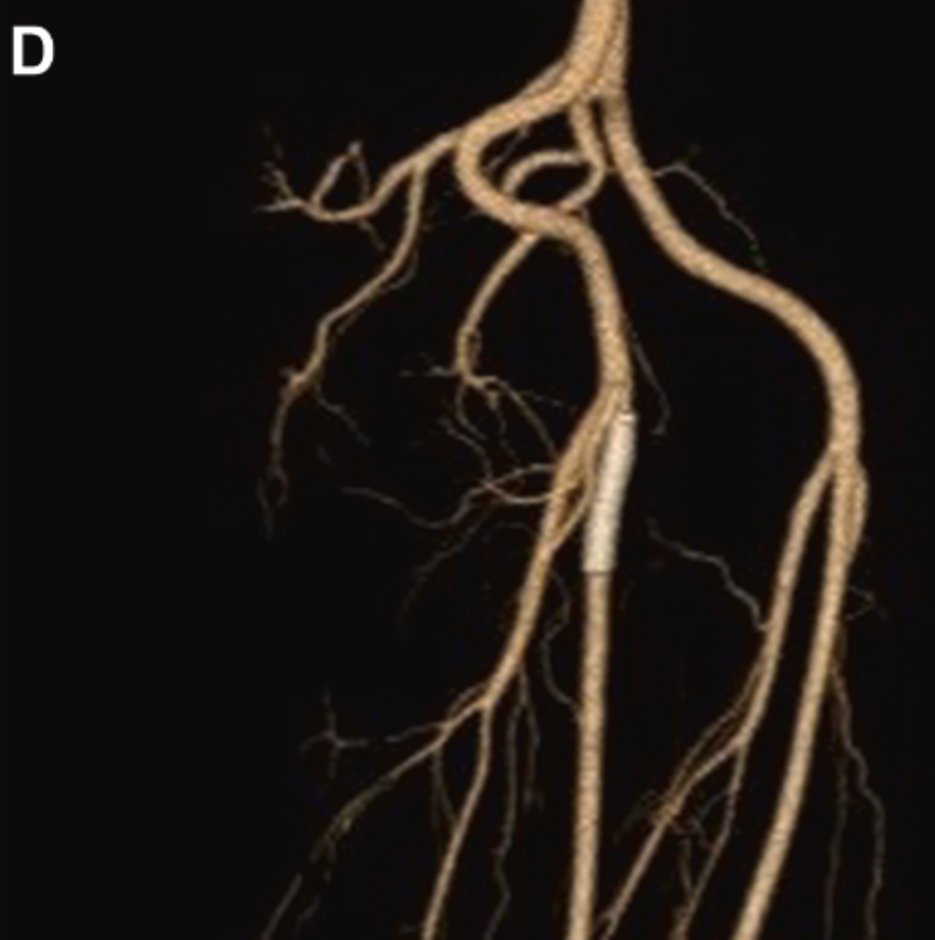 JVS - Venous and Lymphatic Disorders tweet media