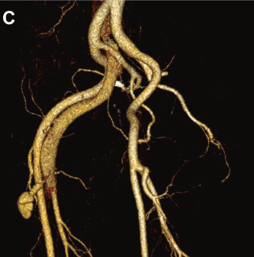 JVS - Venous and Lymphatic Disorders tweet media