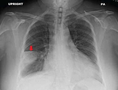 Hampton’s hump is seen in:
A) Pulmonary embolism
B) Pneumonia
C) Tuberculosis
D) Sarcoidosis