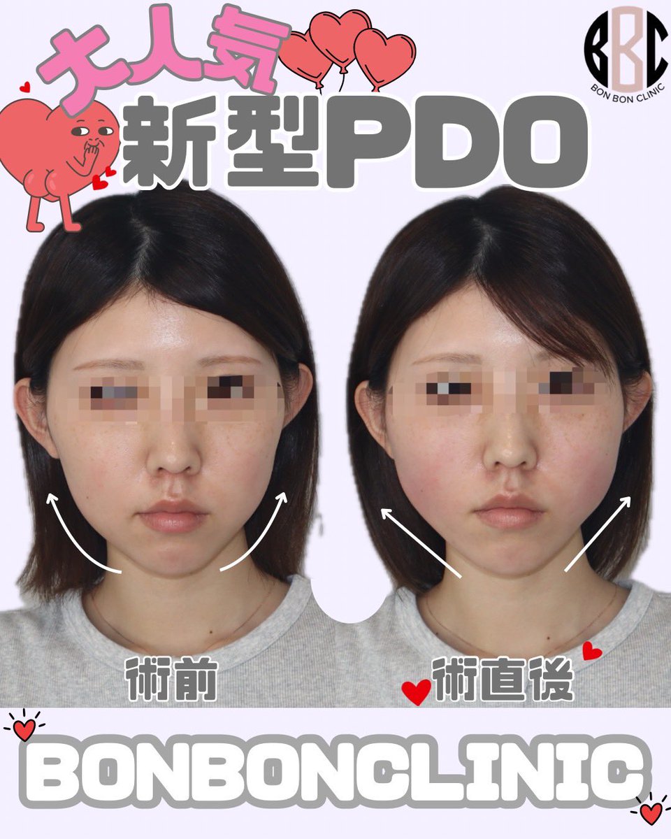BONBONCLINIC's tweet photo. 銀座院💞はる先生　糸リフト症例🫧💞
新型PDOでのお施術です🪄✨

ヒアル・ボトックス・カベリンも
お得なクーポン🎁LINE限定で配布中🌈

📲今すぐチェックしてねっ💌

☎️03-6263-8261
LINE▶️【@bonbonclinic】で検索🔍

#銀座美容 #bonbonclinic #糸リフト #ヒアルロン酸 #ボトックス https://t.co/UOStLC82sG