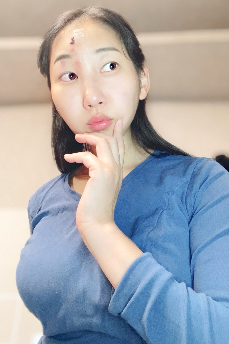 ╭━━━━━━━━━━━━━━╮
　帯状疱疹(ﾀｲｼﾞｮｳﾎｳｼﾝ)って何❓
╰━━ｖ━━━━━━━━━━━╯

こんにちは❗️
さぬきのなっちゃんです🐬

私の顔がびっくりな感じになってますが、病院で先生に第一声「あ、帯状疱疹だね」って言われて「❓❓❓」ってなりました🤣