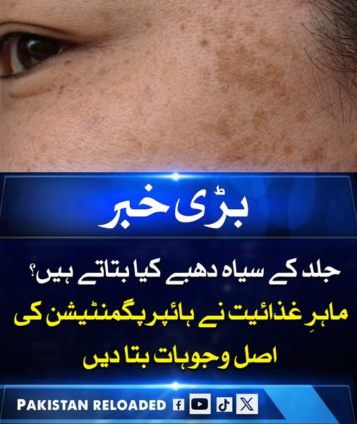 PakReloaded2025's tweet photo. ماہرینِ غذائیت کے مطابق جلد پر سیاہ دھبے یا ہائپرپگمنٹیشن صرف ظاہری مسئلہ نہیں بلکہ یہ انسانی صحت کی اندرونی حالت کی نشاندہی بھی کرتے ہیں۔ اس کے پیچھے خوراک، ہارمونز اور آنتوں کی صحت کے مسائل شامل ہو سکتے ہیں۔ 

#Hyperpigmentation #SkinHealth #NutritionTips #GutHealth #Hormones https://t.co/aWDcGCzOns