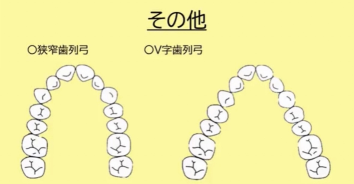 国試で問われやすい歯列弓は3つ。 特に⭐️鞍状歯列弓は重要です。