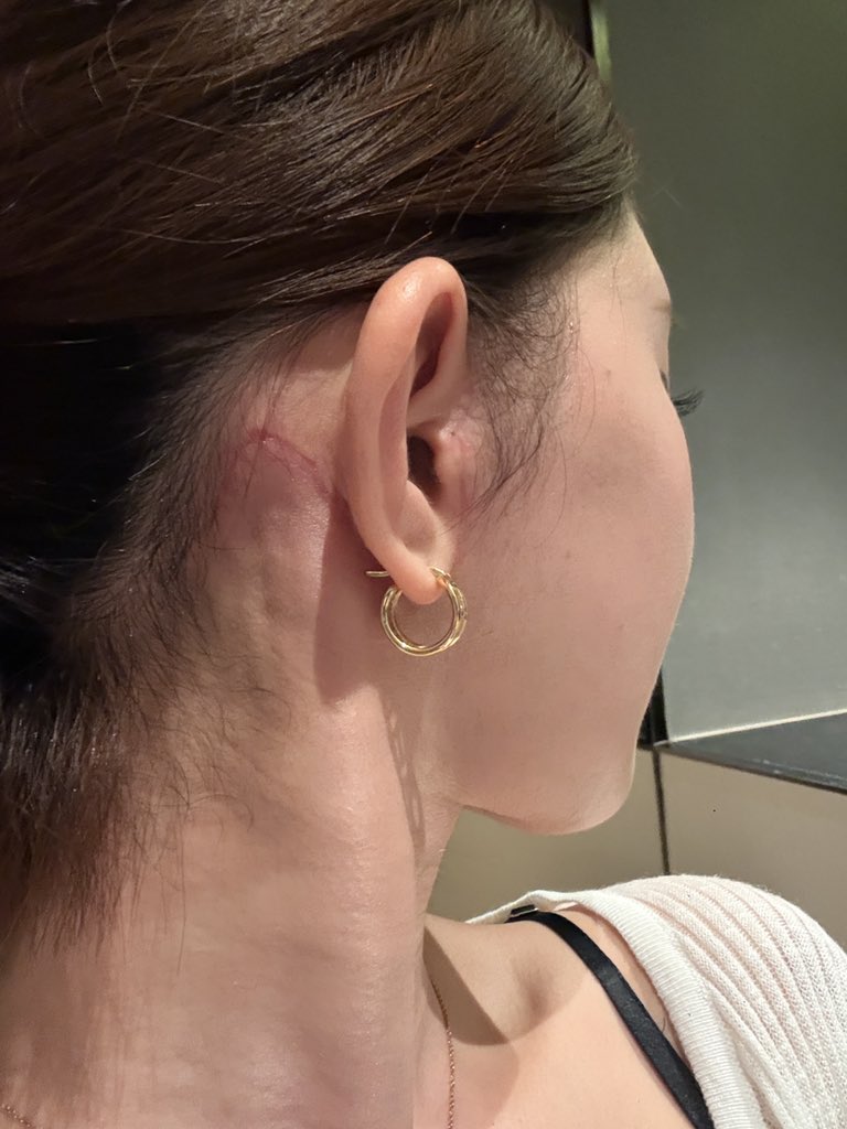supernitochanda's tweet photo. 切開リフト2ヶ月行かないくらい
傷跡こんな感じ
麻痺は頬の所がちょっと感覚ないくらいで突っ張り感とかもない
ほんとーに日に日に顔がちっさくなっていく🥲🥲 https://t.co/wKVwlEXVed