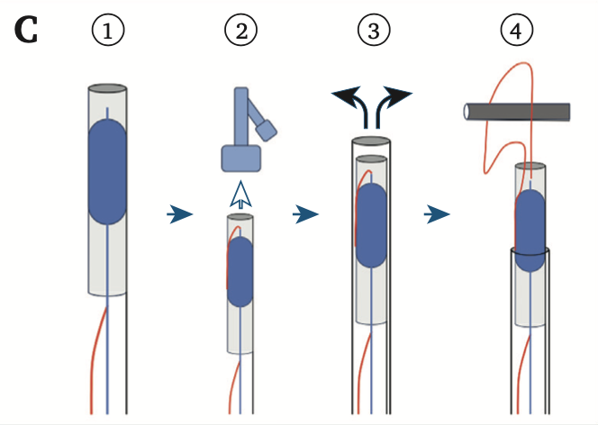 EJVES_ESVS's tweet photo. 🇯🇵 🎯 QUERY: Struggling with Pulmonary Artery Catheter Retrieval? 💥
When standard snares lack the grip: A reliable solution for intravascular foreign body removal.
This Technical Note in #EJVESForum details the ‘RAPID-HANDLE’ technique for the safe and efficient retrieval of embolised catheters.
💡KEY FINDINGS:
· The Challenge: A fractured 10 cm infusion port catheter fragment embolised into the main pulmonary artery, requiring percutaneous retrieval.
· The Innovation: The RAPID-HANDLE technique. It utilises a homemade snare with an adjustable loop combined with a large-diameter introducer sheath (14 F) featuring an adjustable haemostatic valve.
· The Mechanism: The homemade snare allows for precise diameter adjustment to grasp the "side-on" fragment, while the adjustable valve on the sheath prevents blood loss and facilitates the secure withdrawal of the folded catheter.
· Outcome: Successful, bloodless retrieval was achieved without fragment loss or vessel injury.
🚀 TAKEAWAY:
Precision control in percutaneous retrieval of foreign bodies often fails due to poor loop stability or sheath resistance. The RAPID-HANDLE technique offers a cost-effective, adjustable alternative to commercial snares, ensuring that even long, straddling fragments can be retrieved safely from the pulmonary circulation.
Read the full Open Access paper from Kyoto Chubu Medical Centre 👇 https://t.co/lZaK5CkEnV
#EJVESforum #VascTwitter #VascularSurgery #InterventionalRadiology #PulmonaryEmbolism #MedEd #ESVScommunity #VasculaRes #SurgicalInnovation
@vascularis @bazinger_z @FLareyre @MariaKatsarou14 @NicLeoneMD @ESVSmembership @EVST_ESVS @cirsesociety @SIRspecialists @VascularSVS @anzsvs