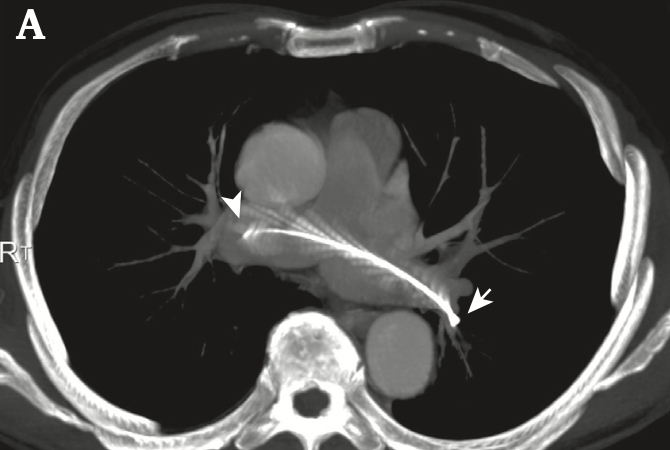EJVES_ESVS's tweet photo. 🇯🇵 🎯 QUERY: Struggling with Pulmonary Artery Catheter Retrieval? 💥
When standard snares lack the grip: A reliable solution for intravascular foreign body removal.
This Technical Note in #EJVESForum details the ‘RAPID-HANDLE’ technique for the safe and efficient retrieval of embolised catheters.
💡KEY FINDINGS:
· The Challenge: A fractured 10 cm infusion port catheter fragment embolised into the main pulmonary artery, requiring percutaneous retrieval.
· The Innovation: The RAPID-HANDLE technique. It utilises a homemade snare with an adjustable loop combined with a large-diameter introducer sheath (14 F) featuring an adjustable haemostatic valve.
· The Mechanism: The homemade snare allows for precise diameter adjustment to grasp the "side-on" fragment, while the adjustable valve on the sheath prevents blood loss and facilitates the secure withdrawal of the folded catheter.
· Outcome: Successful, bloodless retrieval was achieved without fragment loss or vessel injury.
🚀 TAKEAWAY:
Precision control in percutaneous retrieval of foreign bodies often fails due to poor loop stability or sheath resistance. The RAPID-HANDLE technique offers a cost-effective, adjustable alternative to commercial snares, ensuring that even long, straddling fragments can be retrieved safely from the pulmonary circulation.
Read the full Open Access paper from Kyoto Chubu Medical Centre 👇 https://t.co/lZaK5CkEnV
#EJVESforum #VascTwitter #VascularSurgery #InterventionalRadiology #PulmonaryEmbolism #MedEd #ESVScommunity #VasculaRes #SurgicalInnovation
@vascularis @bazinger_z @FLareyre @MariaKatsarou14 @NicLeoneMD @ESVSmembership @EVST_ESVS @cirsesociety @SIRspecialists @VascularSVS @anzsvs