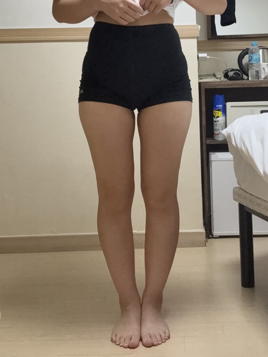 mi_woo28's tweet photo. レアートさんで太もも、ヒップライン脂肪吸引して3ヶ月経過しました。
悩んでた太ももの付け根が細くなってずっと履きたかった短パンも履けるようになって感動🥹✨
まだまだこれからの経過が楽しみです❣️
#レアート　#ソ院長 https://t.co/LYGk3PdcoX