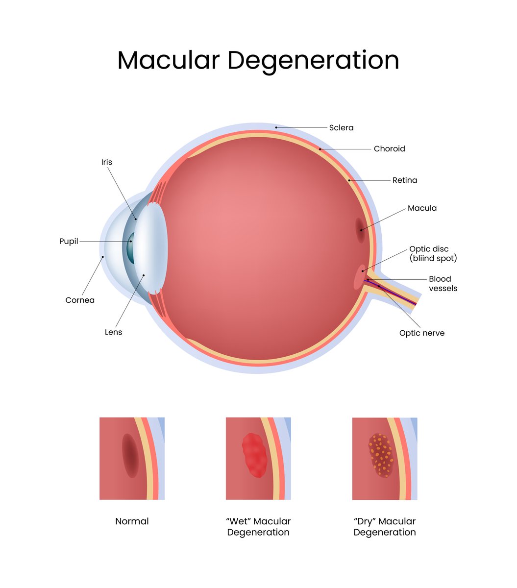 Age-related Macular Degeneration is the largest cause of sight-loss in Ireland affecting OVER 100,000 people with 7% of people over 50 living with this condition - please get in touch if you have ANY concerns. 

Find out more here: fightingblindness.ie/living-with-si…

#AMD #Galway