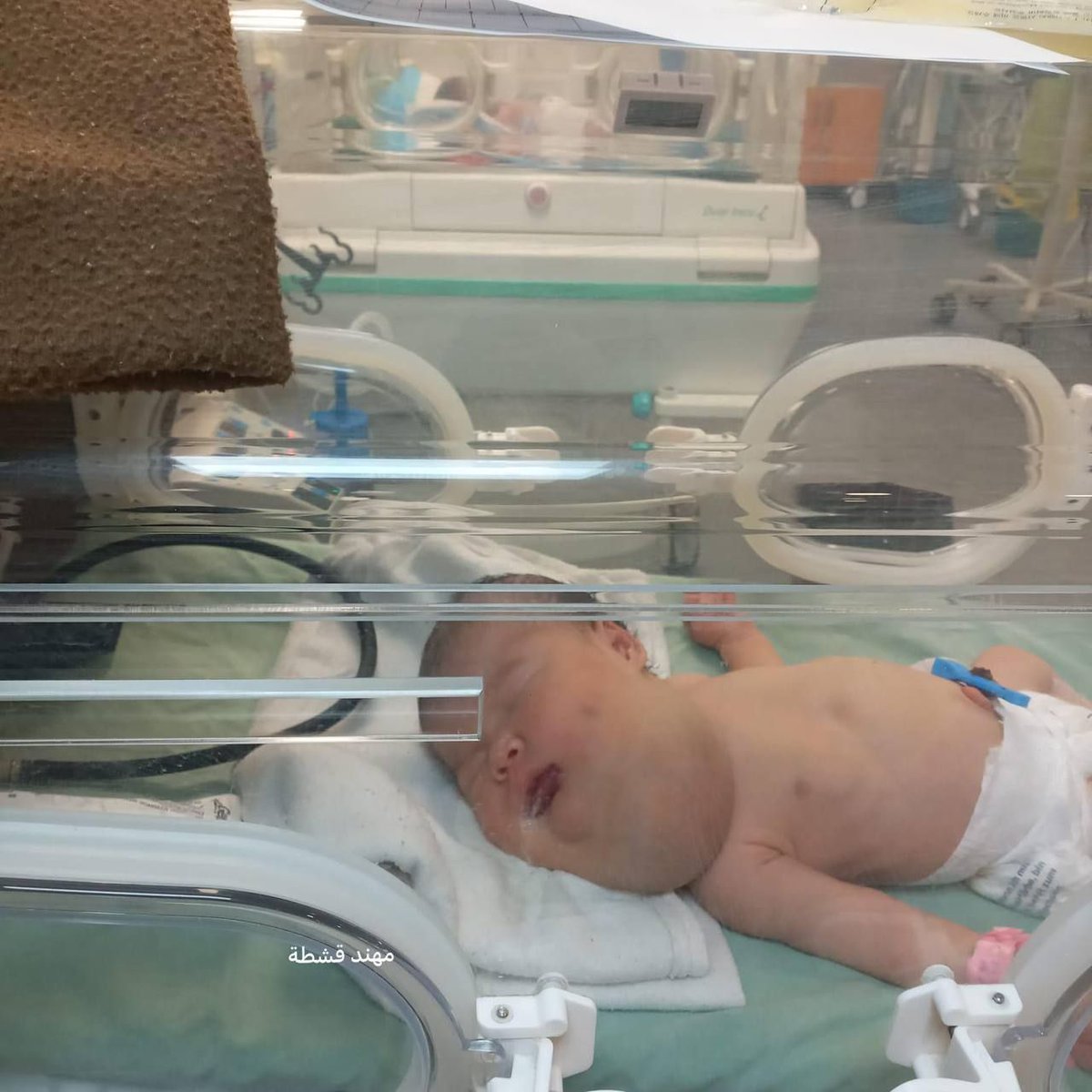 الطفلة: حور قشطة، تبلغ من العمر 4 أيام، تعاني من انتفاخ نادر وخطير في منطقة الحلق، ما يؤثر بشكل مباشر على التنفس والرضاعة..

حالـتها الصحية حرجة، وتحتاج إلى تحويلة طبية فورية وعاجلة لإنقاذ حياتها.