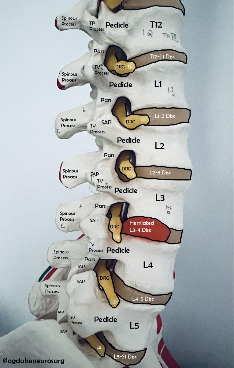 OGdukeneurosurg's tweet image. Hand-crafted spine
anatomy art: See the lumbar levels up close, with a prominent L3-4 disc herniation pressing on the nerve root. Labeled landmarks like pedicles, pars, and facets make this perfect for learning why pain radiates down the leg.
What surprises you most about spine…