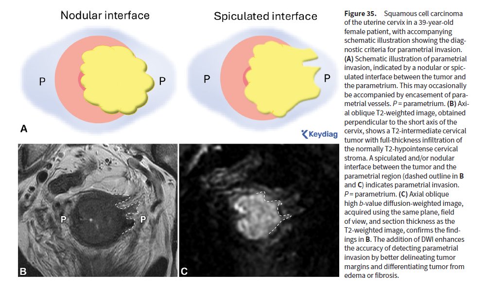 📣 Excellent article in RadioGraphics: “Reference Handbook of Gynecologic Pelvic MRI”

pubs.rsna.org/doi/10.1148/rg…

✅Tailored protocols
✅Normal pelvic anatomy with excellent illustrations and MR images
✅Step-by-step lesion characterization ✅Structured reporting for adnexal