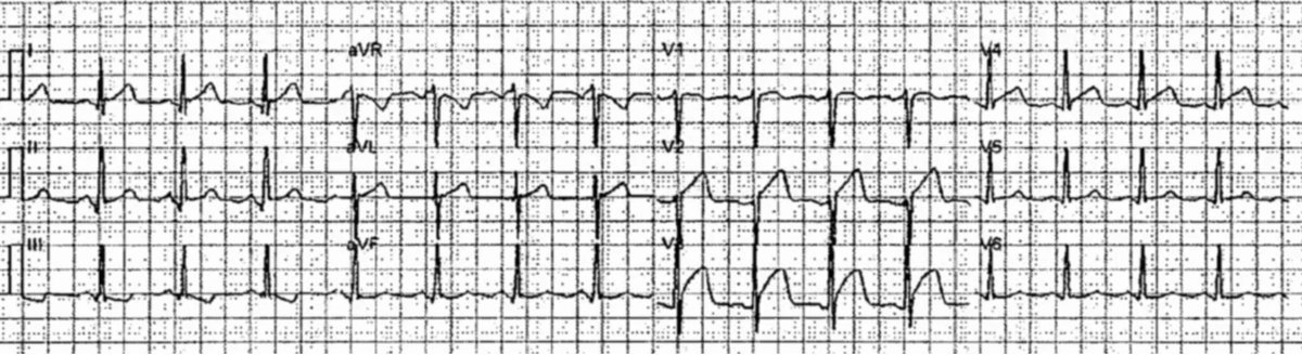 smithECGBlog's tweet photo. Acute chest pain in a 50-something: resolves, recurs, resolves: Does the ED ECG show “Early Repol”?

https://t.co/GPCO87XJP5 https://t.co/oYxacFuYye
