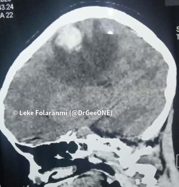 DrGeeONE's tweet image. 1/2
I need your thoughts on this;
10-year old with a sudden onset of left hemiparesis and recurrent seizures. 
CT-right parietal lesion with associated haematoma
MRI shows a well-circumscribed lesion with a "popcorn" appearance.
Working diagnosis: Cavernous malformation 
#CNSPath