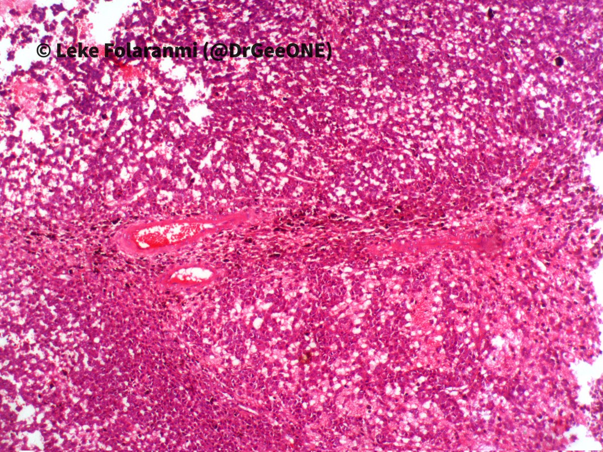 DrGeeONE's tweet image. 1/2
I need your thoughts on this;
10-year old with a sudden onset of left hemiparesis and recurrent seizures. 
CT-right parietal lesion with associated haematoma
MRI shows a well-circumscribed lesion with a "popcorn" appearance.
Working diagnosis: Cavernous malformation 
#CNSPath