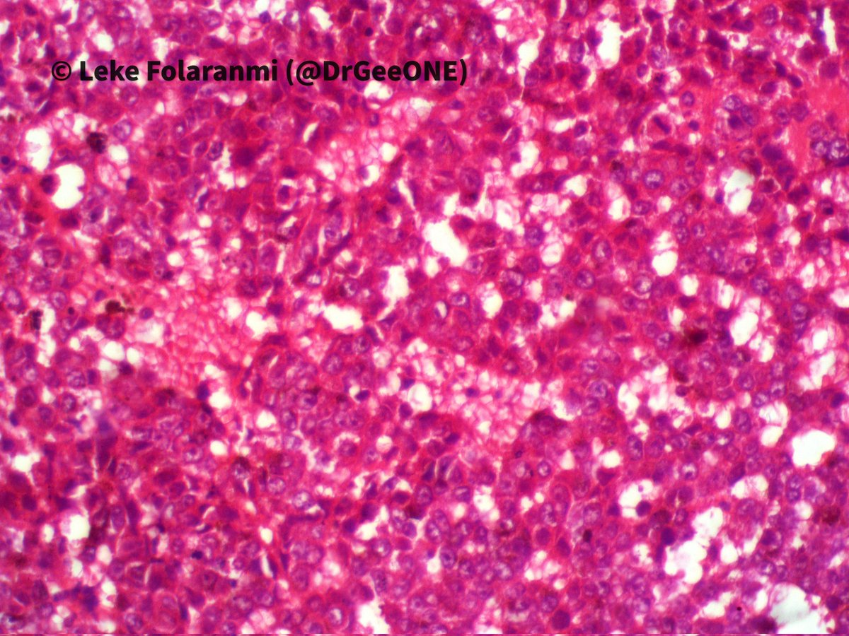 DrGeeONE's tweet image. 1/2
I need your thoughts on this;
10-year old with a sudden onset of left hemiparesis and recurrent seizures. 
CT-right parietal lesion with associated haematoma
MRI shows a well-circumscribed lesion with a "popcorn" appearance.
Working diagnosis: Cavernous malformation 
#CNSPath