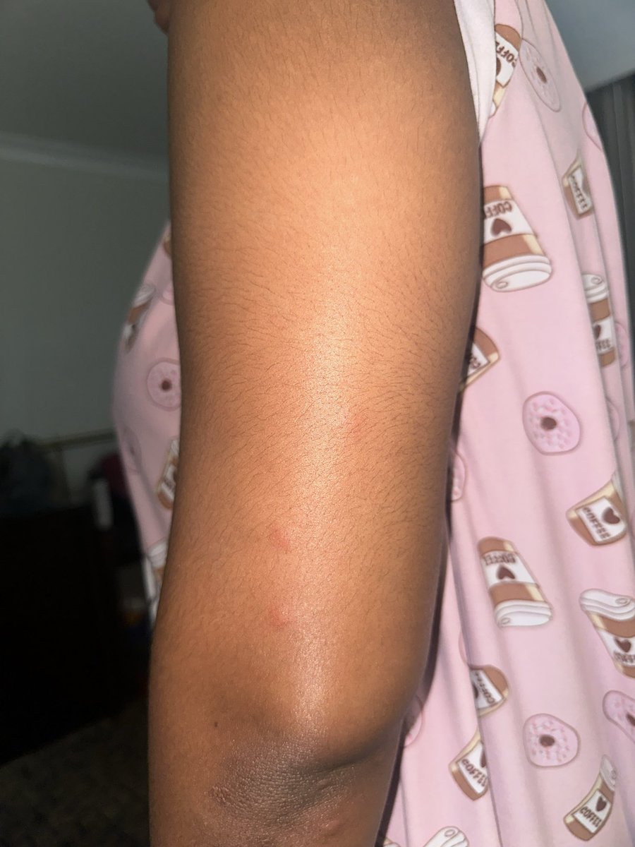 Pretti_Gyrlz's tweet photo. Visited @sheratonhotels  in Myrtle Beach and was bite. They don’t want people to know this and trying to keep me hush hush saying it was in the air. How TF is this even possible. Laid down without bites wake up with bites. Make it make sense. What do you call this ish? https://t.co/qU4q03DgJe