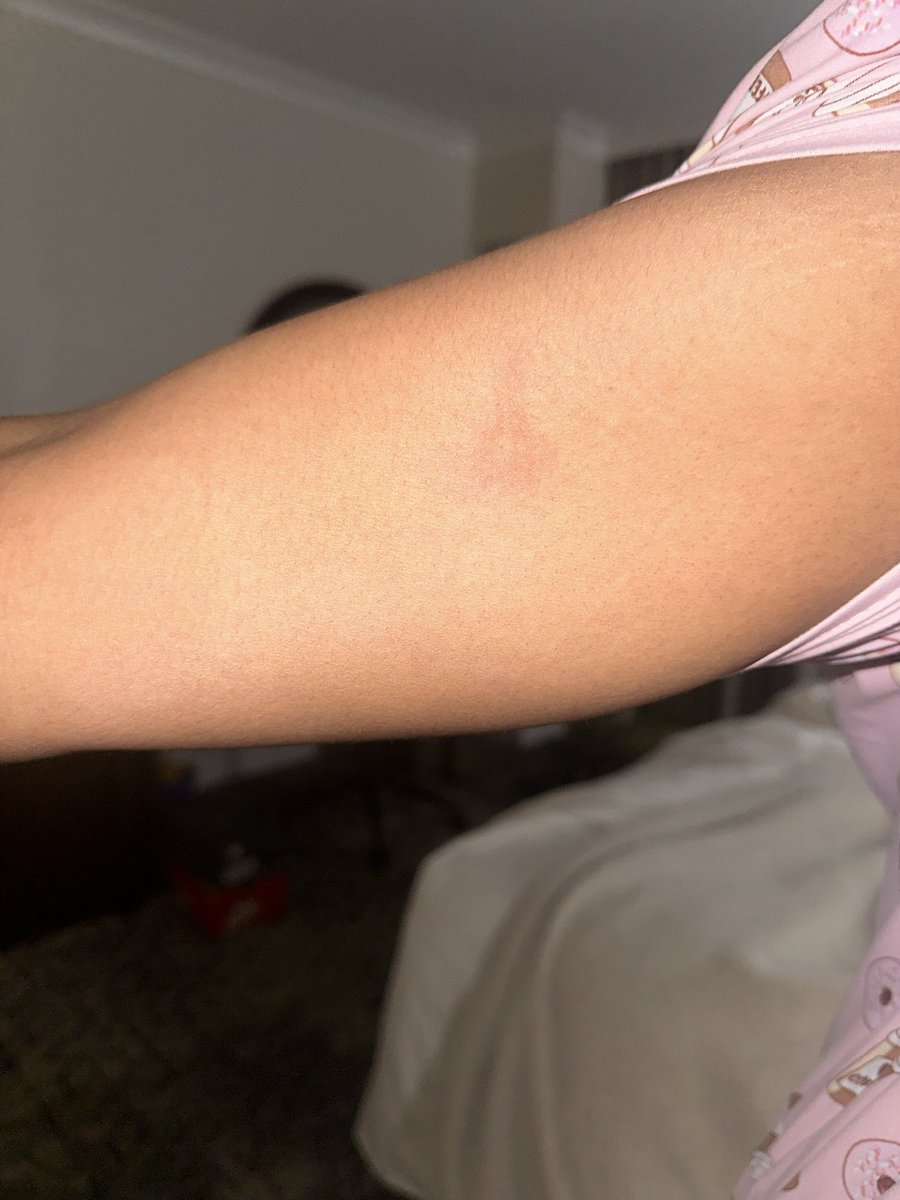 Pretti_Gyrlz's tweet photo. Visited @sheratonhotels  in Myrtle Beach and was bite. They don’t want people to know this and trying to keep me hush hush saying it was in the air. How TF is this even possible. Laid down without bites wake up with bites. Make it make sense. What do you call this ish? https://t.co/qU4q03DgJe