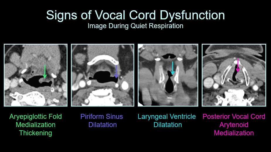 ESHNRSociety's tweet photo. 🎙️ Join the ESHNR Webinar!
📅 Jan 27 | ⏰ 18:00 CET
Imaging Approach to Dysphonia
👨‍⚕️ Speaker: @Alok_A_Bhatt
🎓 Moderator: @SalmanQureshiDr
🔗 Register: https://t.co/9kVZA8qj42
📖 Related reading: https://t.co/6W1QTr4iLW Insights into Imaging

👀 A sneak preview of the talk https://t.co/viob4qma6g