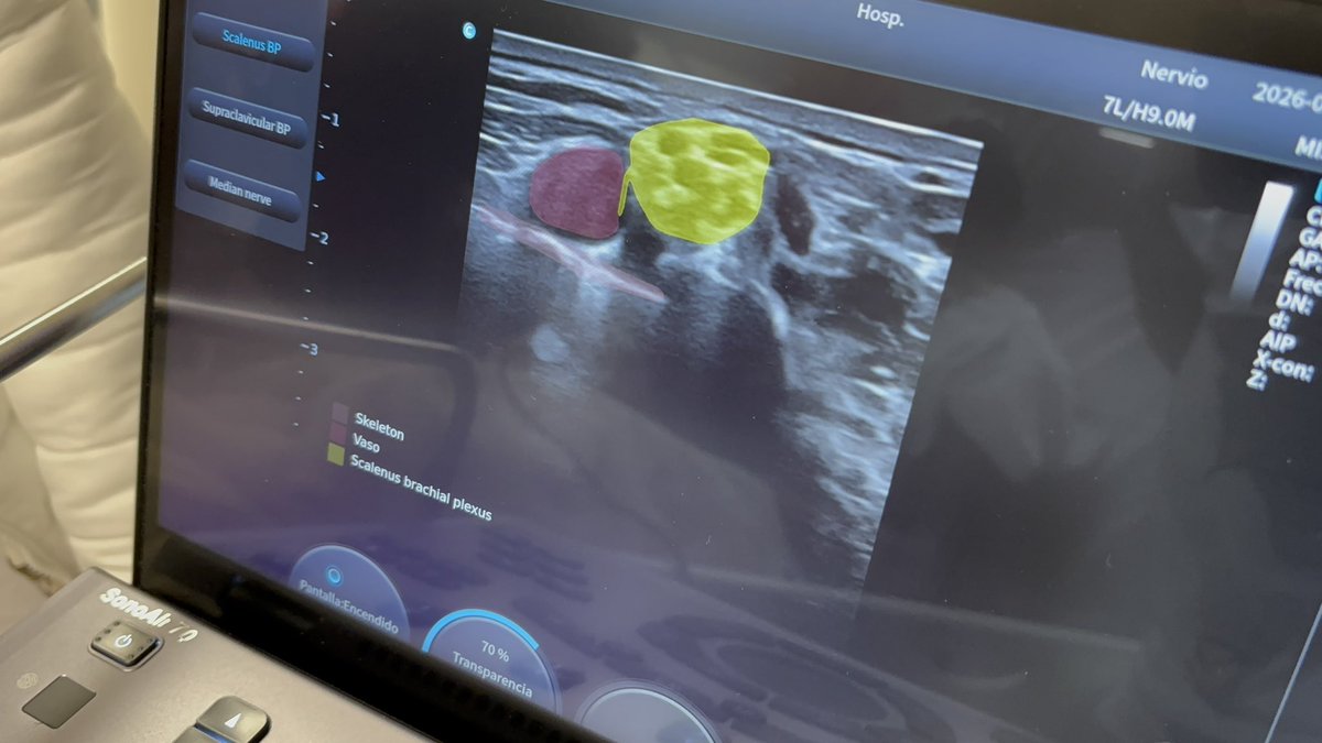 Dr_Dive's tweet photo. La analgesia ecoguiada en Urgencias nos permite:
✅ Facilitar reducciones
✅ Evitar sedación profunda
✅ Disminuir complicaciones
✅ Respetar al paciente
Aquí no es solo técnica. Es #humanizar la atención.
Hoy lo hacemos posible con apoyo de #CHISON #SonoAir, utilizando #SonoNerve para identificar estructuras nerviosas y vasculares de forma más precisa, haciendo el procedimiento más seguro y acortando la curva de aprendizaje.
Orgulloso del trabajo conjunto de los residentes de #Urgencias y Traumatología y Ortopedia, demostrando que la colaboración eleva la calidad.
POCUS no es moda….. es un estándar de atención.
@sonoeye @Berrysophie